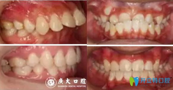 廣州廣大口腔牙齒矯正對比圖