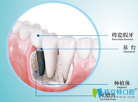 什么是種植牙 長(zhǎng)沙雅美口腔醫(yī)生詳解種植牙優(yōu)缺點(diǎn)/注意事項(xiàng)