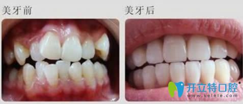 廣州華美李醫(yī)生隱適美矯正前后對(duì)比效果】 廣州華美李醫(yī)生隱適美矯正前后對(duì)比效果】