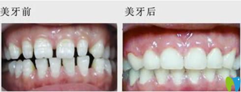 廣州華美口腔李敏華牙齒稀疏矯正前對(duì)比圖 廣州華美口腔李敏華牙齒稀疏矯正前對(duì)比圖