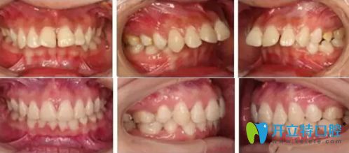 廣州廣大口腔做牙齒正畸怎么樣?齙牙/牙齒擁擠真人案例反饋