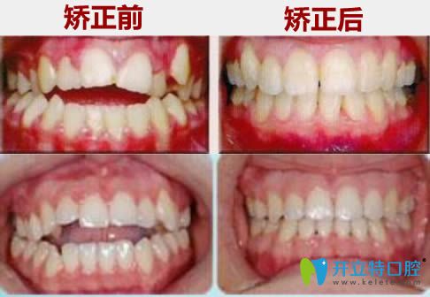 廣州華美前牙開頜正畸前后對比效果