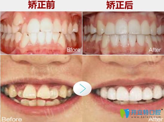 廣州華美口腔牙齒擁擠和虎牙矯正前后對比照