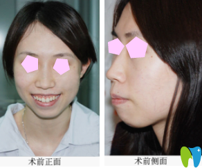 湛江南方口腔牙齒矯正案例術前照