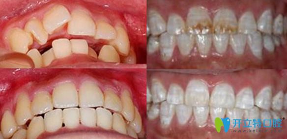 佛山粵冠牙科正畸美白案例對比圖 佛山粵冠牙科正畸美白案例對比圖