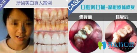 佛山粵冠牙科牙齒美白及修復圖