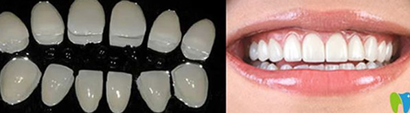 黃牙怎么形成 ?深圳嵐世紀(jì)口腔介紹瓷貼面美白牙齒優(yōu)缺點(diǎn)