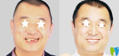 惠州麥芽口腔多顆牙缺失種植效果案例