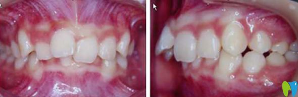 中山好民生口腔沒(méi)做牙齒矯正前的照片 中山好民生口腔沒(méi)做牙齒矯正前的照片
