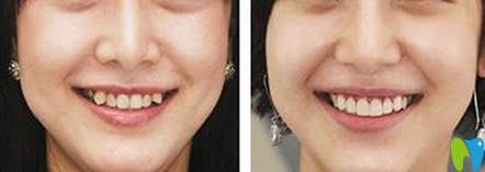 清遠中大口腔牙齒矯正前后效果對比圖