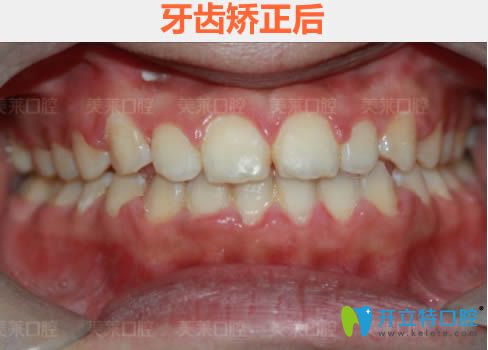 在廣州美萊口腔做完時(shí)代天使隱形矯正18個(gè)月效果