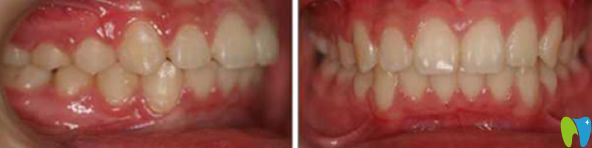 好民生口腔牙齒矯正后的<span style= 好民生口腔牙齒矯正后的<span style=