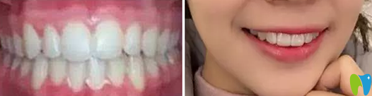 中山香山口腔譚智堅院長給我做隱形牙齒矯正一年的效果 中山香山口腔譚智堅院長給我做隱形牙齒矯正一年的效果