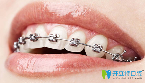 <!--<i data=20240703-sp></i>-->口腔金屬托槽矯正技術(shù)