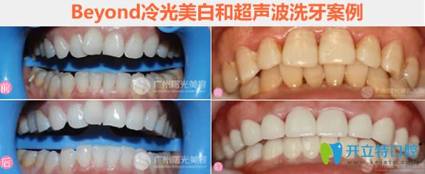 Beyond冷光美白和超聲波洗牙前后對比圖