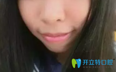 沒有去深圳河山齒科前次矯正兩年后的照片