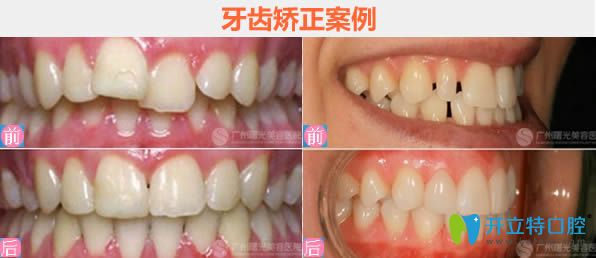 廣州曙光王浩主任隱形牙齒矯正前后對比效果