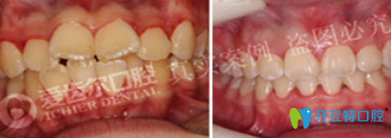 武漢愛齒爾口腔好不好？來看牙齒矯正案例
