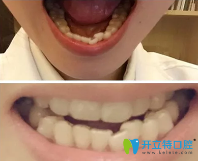 廣州拜博口腔怎么樣，28歲隱形牙齒矯正前后對比照片來揭曉