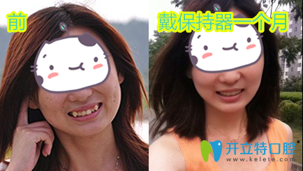 愛齒爾口腔牙齒矯正前后效果對比圖