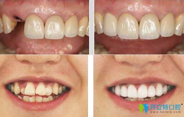 北京瑞泰牙齒矯正及種植牙前后對比效果圖