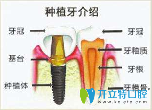廣州好大夫口腔“分分鐘”微創(chuàng)無(wú)痛即種即用種植牙介紹