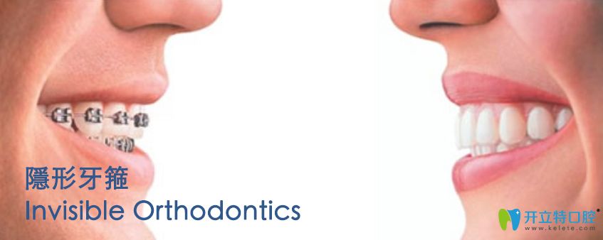 香港思傑口腔隱形牙箍