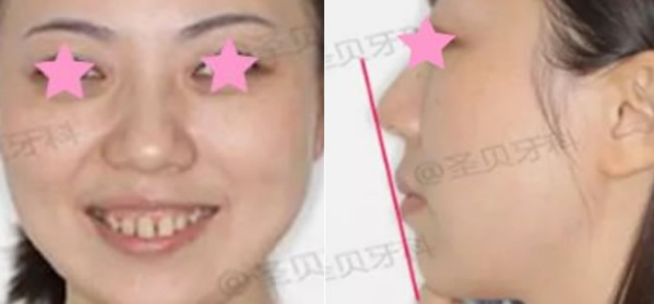 笑起來露牙齦怎么矯正 成都圣貝口腔牙齒矯正案例教您方法