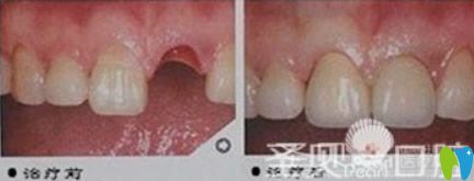 圣貝口腔黃祎銘醫(yī)生單顆牙缺失種植效果<span style= 圣貝口腔黃祎銘醫(yī)生單顆牙缺失種植效果<span style=