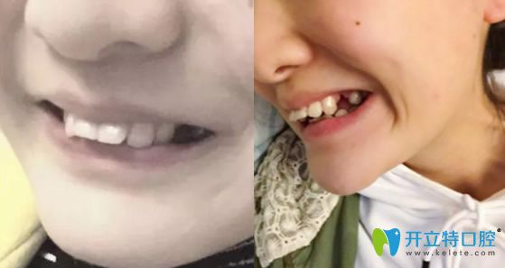 沒有去北京康貝佳口腔做牙齒正畸前照片