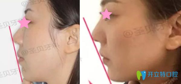 成都圣貝齒科矯正牙齒一年后效果