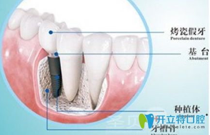 種植牙由種植體基臺(tái)烤瓷冠三部分組成部分 種植牙由種植體基臺(tái)烤瓷冠三部分組成部分