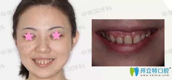 成都圣貝齒科露齦笑矯正前