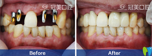 北京冠美口腔多顆牙種植前后效果對比圖