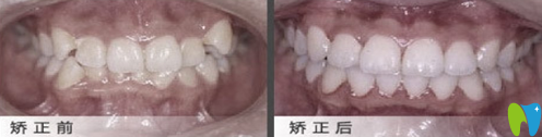 在北京佳美口腔做牙弓形態(tài)異常矯正案例治療效果對比