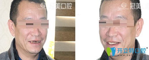 冠美口腔種植牙前后效果對比圖