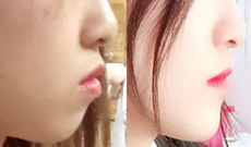 北京佳美口腔牙齒矯正560天來曬照 大家覺得正畸后變化大嗎