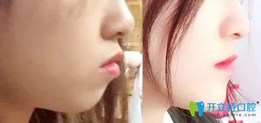 牙齒矯正能改變臉行嗎？看佳美口腔牙齒矯正前后對比照片知