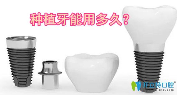 鄭建偉告訴你:種植牙能用多久 鄭建偉告訴你:種植牙能用多久