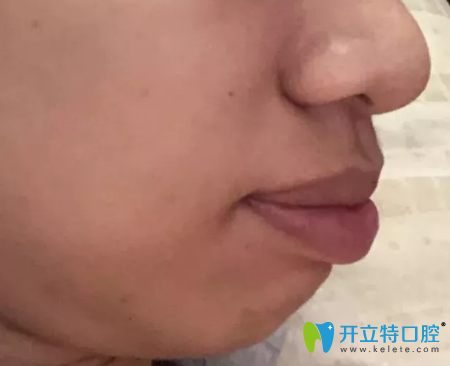 弘和口腔齙牙齒矯正第400天變化圖