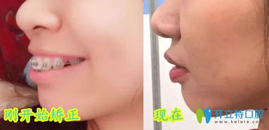 深圳弘和口腔齙牙前突矯正后對比照