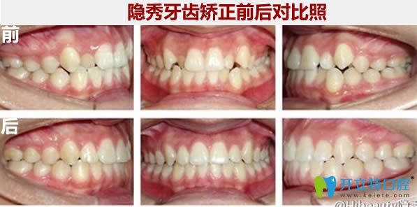 隱秀牙齒矯正前后對(duì)比