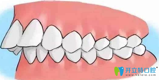 修復(fù)齙牙多少錢？齙牙矯正方法及價(jià)格表分享