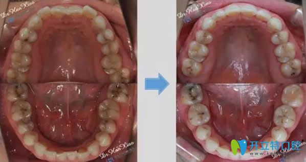 <!--<i data=20240703-sp></i>-->科瓦齒科正畸前后效果對(duì)比圖