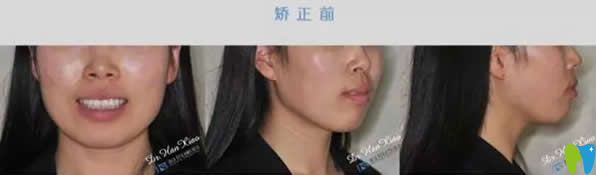 <!--<i data=20240703-sp></i>-->科瓦齒科矯正牙齒前