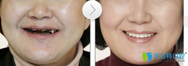 老年人全口種植牙前后對(duì)比圖