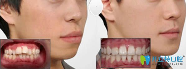 北京美年牙科齙牙前突矯正后對比圖