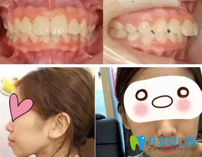上海科美口腔怎么樣？看了我28歲牙齒矯正前后照片真是后悔