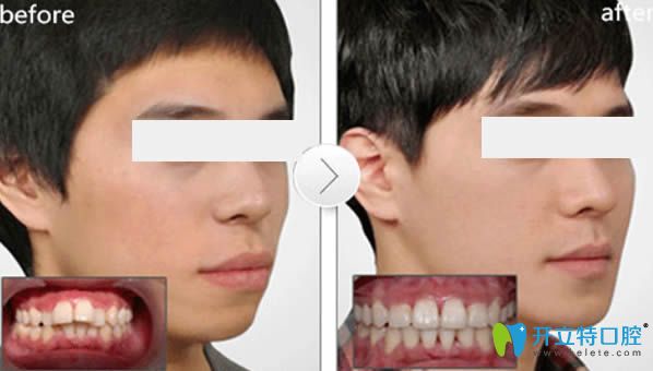 時(shí)代天使隱形牙齒矯正前后對(duì)比照