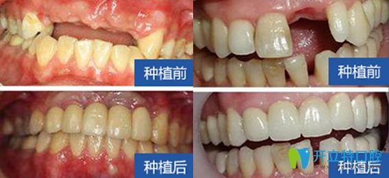 西安雁塔惟真口腔怎么樣？百萬(wàn)真實(shí)案例，彰顯種植優(yōu)勢(shì)